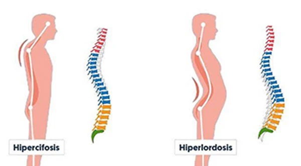 esquema de hipercifosis e hiperlordosis
