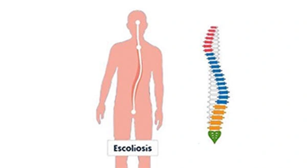 Esquema de escoliosis
