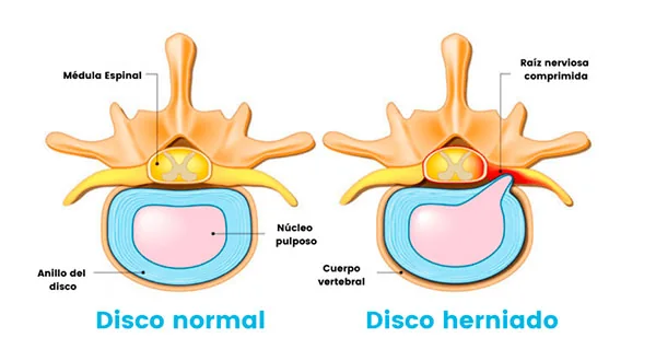 Esquema de hernia discal. Patología que produce dolencias en la columna y se tiene en cuenta en Pilates
